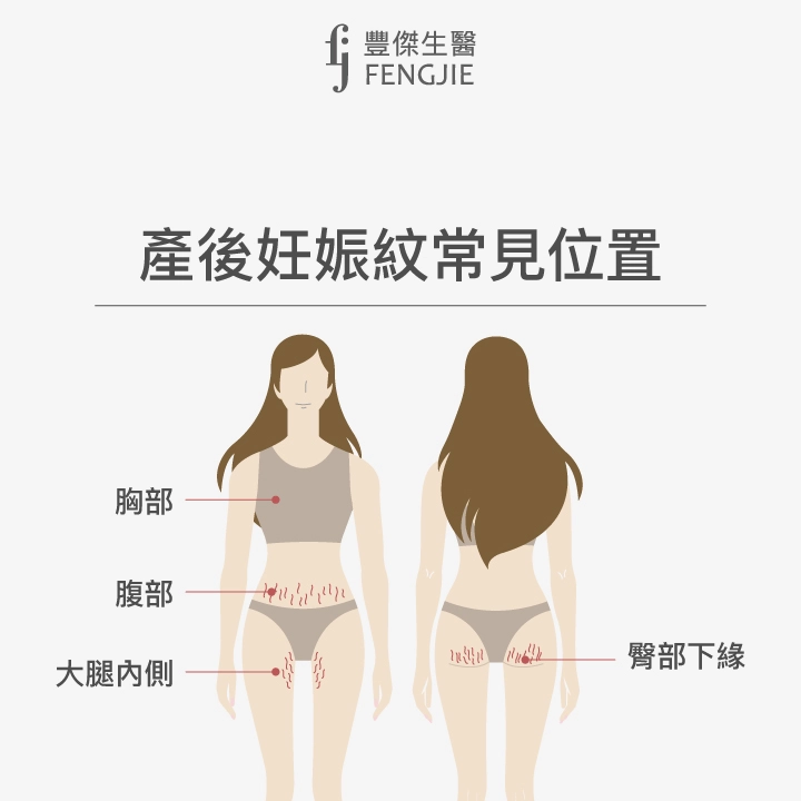 產後妊娠紋常見位置：腹部、胸部、臀部下緣、大腿內側
