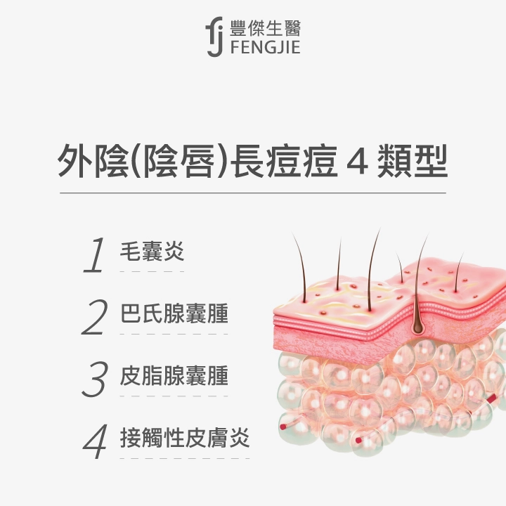 外陰（陰唇）長痘痘4類型：毛囊炎、巴氏腺囊腫、皮脂腺囊腫、接觸性皮膚炎