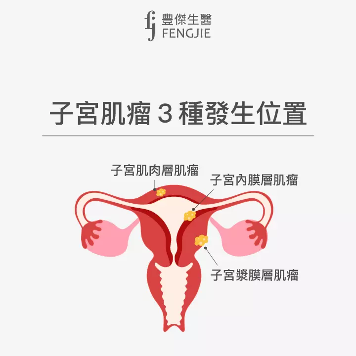 子宮肌瘤3種發生位置：子宮肌肉層肌瘤、子宮漿膜層肌瘤、子宮內膜層肌瘤