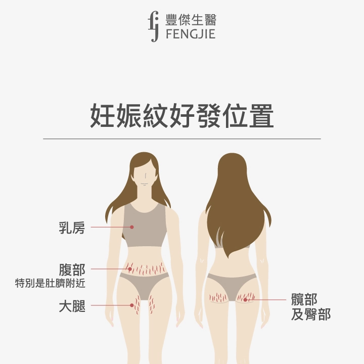 腹部、乳房、上臂、腋下、背後、大腿內外側、髖部及臀部都是妊娠紋容易出現的部位