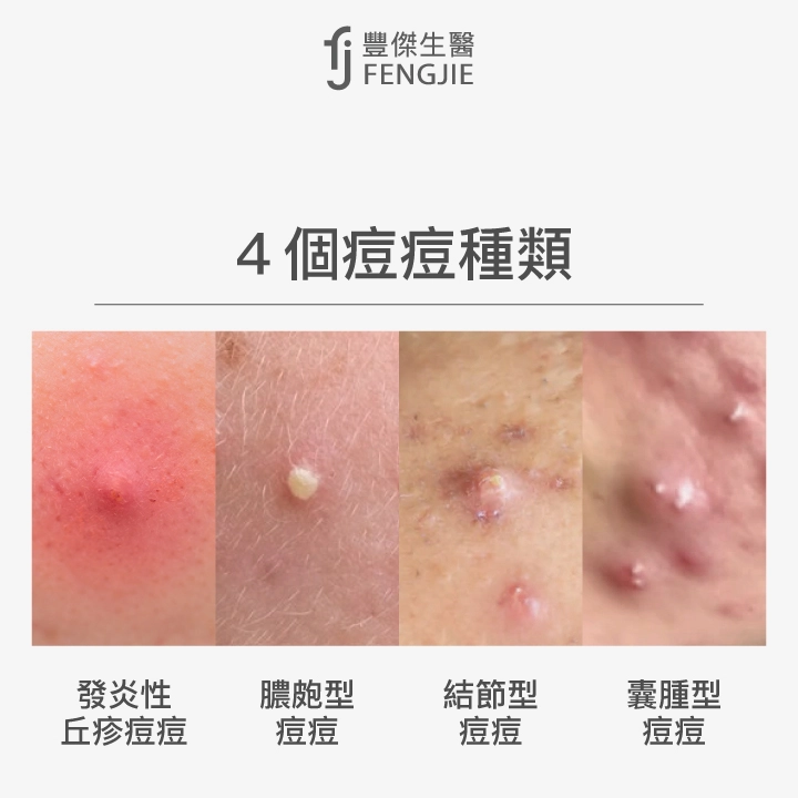 4個痘痘種類：發炎性丘疹痘痘、膿皰型痘痘、結節型痘痘、囊腫型痘痘